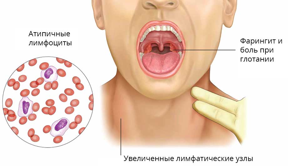 Вирус Эпштейна-Барр: симптоматика и лечение