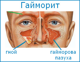 Гайморит: прокол неизбежен?