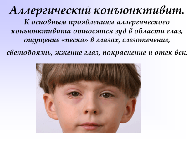 Конъюнктивит глаз: виды заболевания и способы лечения у детей