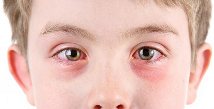Красные глаза у ребенка: отчего возникает этот симптом и о каких заболеваниях говорит?