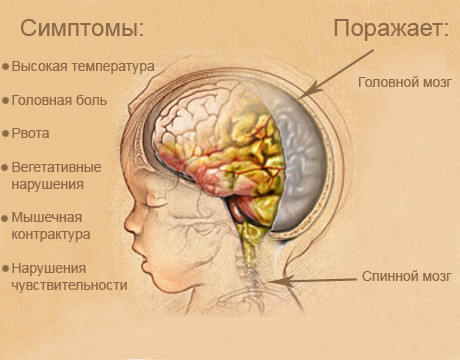 Лечение менингита у детей, причины и симптомы