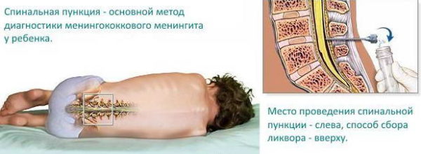 Лечение менингита у детей, причины и симптомы