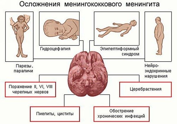 Лечение менингита у детей, причины и симптомы