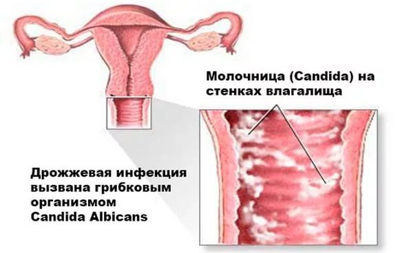 Симптомы и лечение молочницы при беременности